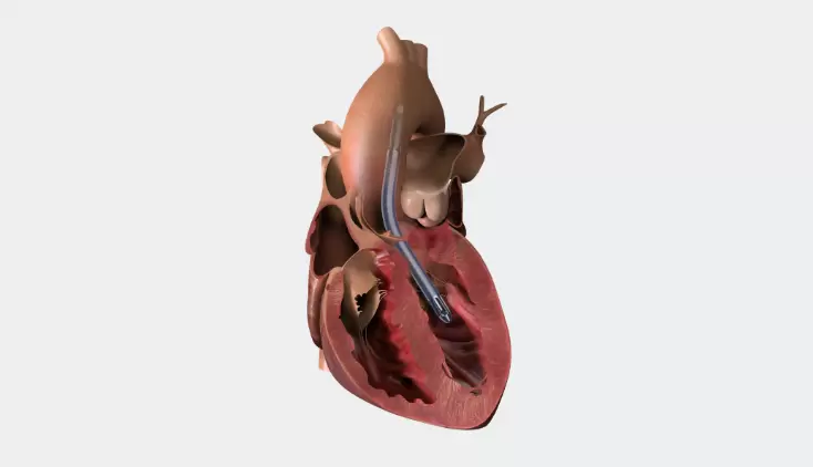 Impella 5.5® with SmartAssist® Datasheet teaser image