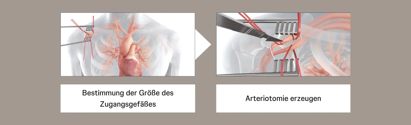 Step-by-Step-Axillary_CreateArteriotomy