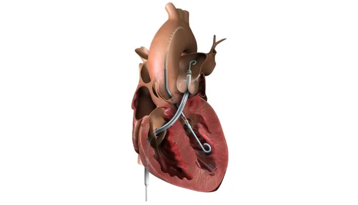 Impella Management Tools teaser image