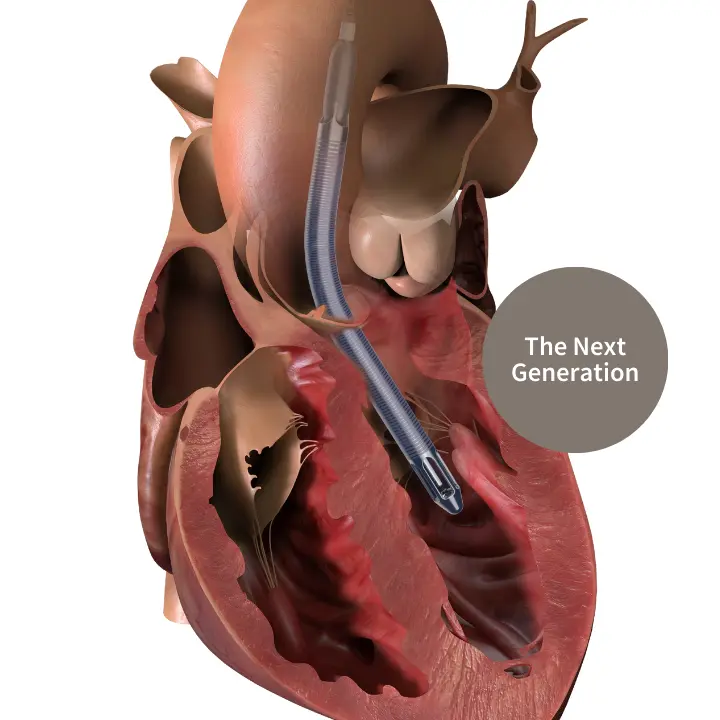 Impella 5.5ᵀᴹ with SmartAssistᵀᴹ Heart Pump