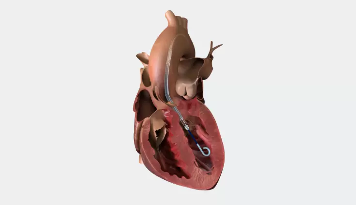 FAQ: Is There Randomized Controlled Trial Data Available for Impella® Heart Pump Use in Cardiogenic Shock?
