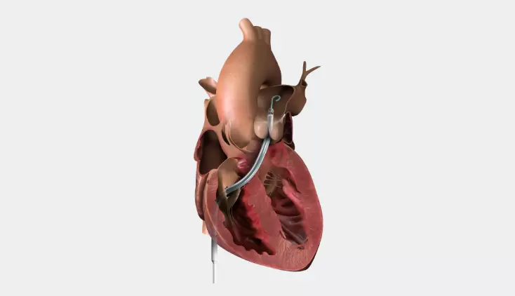 Right Heart Failure/Right Ventricular Dysfunction and the Impella RP Flex<sup>™</sup> with SmartAssist<sup>™</sup> Heart Pump