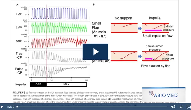 Impact of Impella® on Dissected Coronary Artery Hemodynamics
