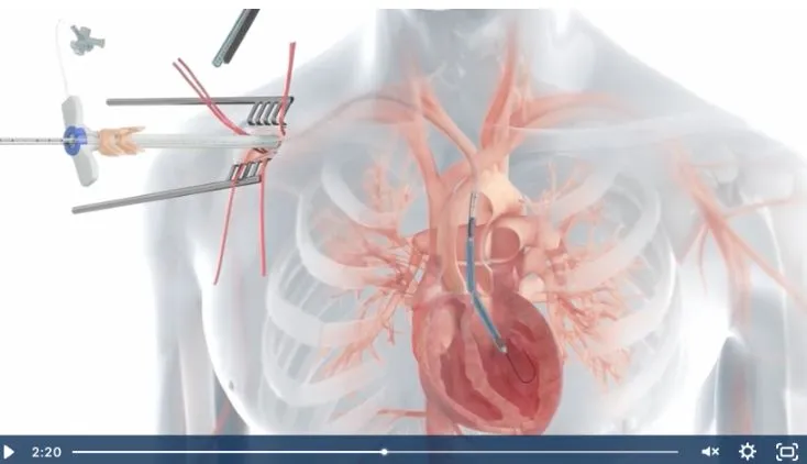 Axillary Insertion of Impella 5.5<sup>™</sup> with SmartAssist<sup>™</sup>