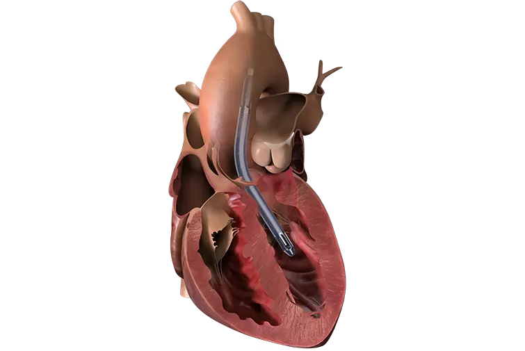 Impella 5.5™ with SmartAssist™ Step-by-Step Direct Aortic Insertion media custom image