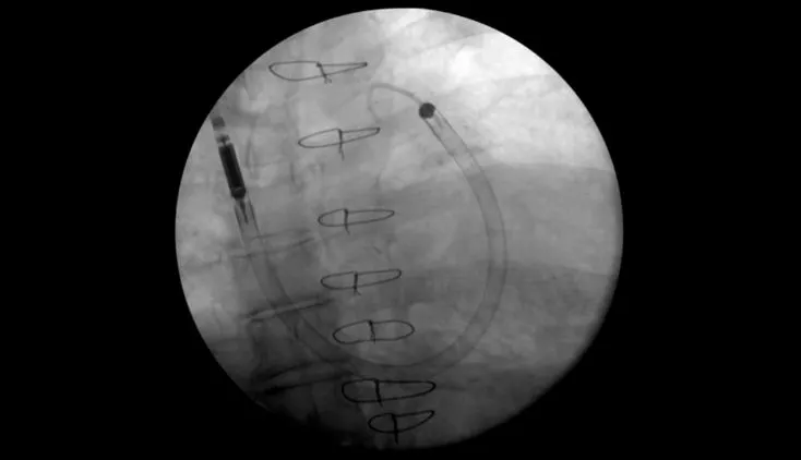 Impella RP Flex<sup>™</sup> IJ Insertion into Cadaver