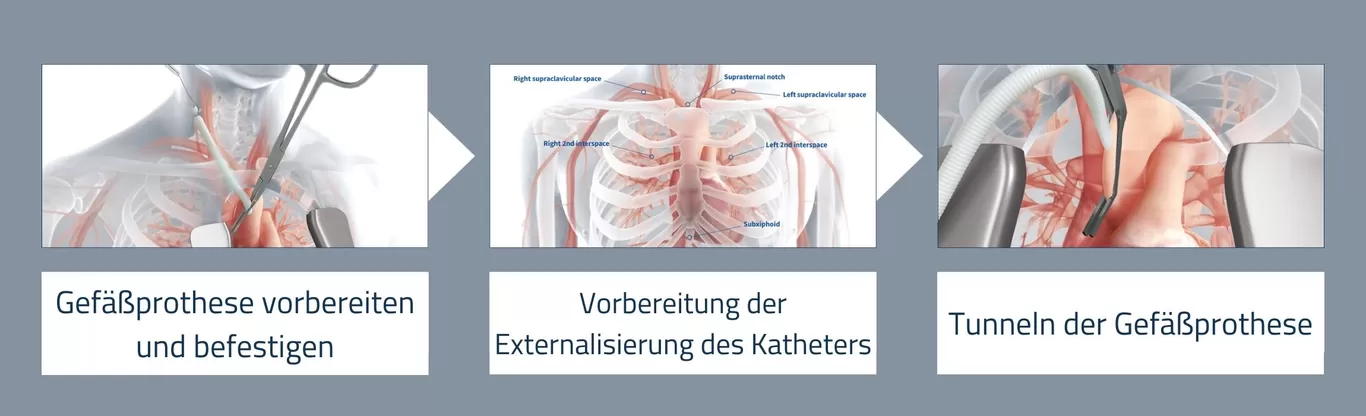 Step-by-Step-Direct-Aortic_PrepareAttachTunnelGraft