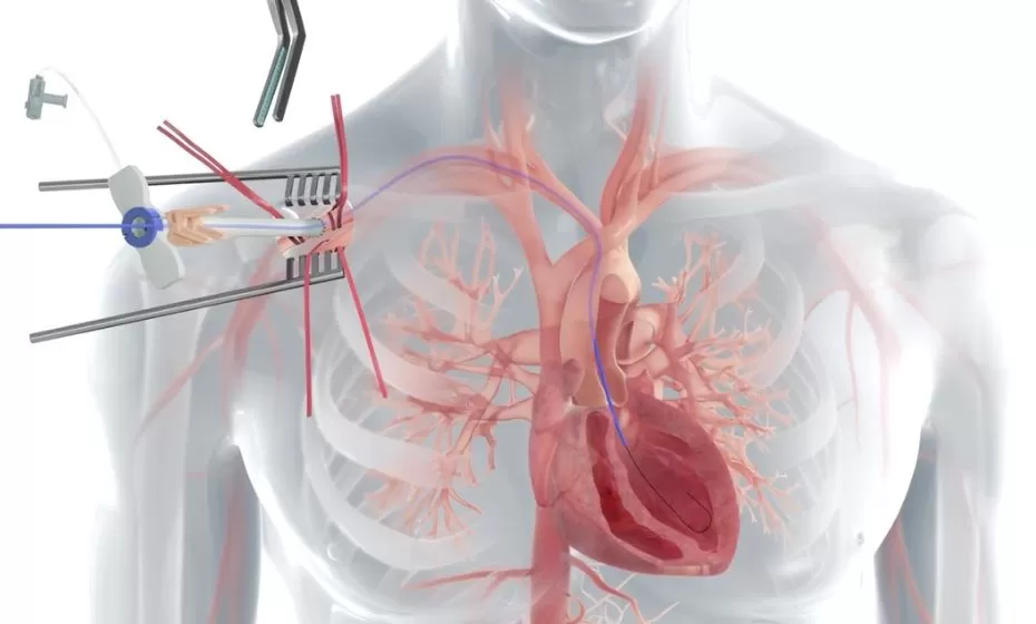 Schritt-für-Schritt-Anleitung zur axillaren Einführung - Impella 5.5 mit SmartAssist Herzpumpe