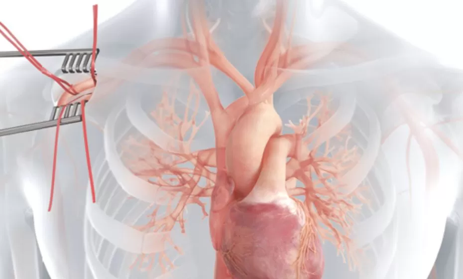 Direkter aortaler Einsatz der Impella 5.5® mit SmartAssist® Herzpumpe