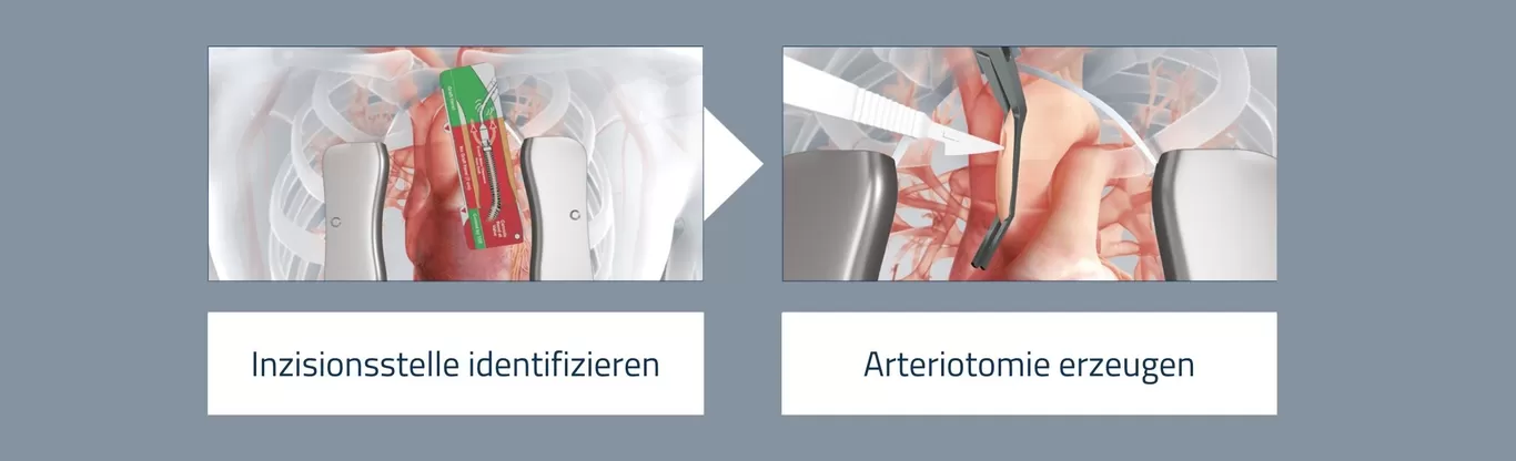 Step-by-Step-Axillary_CreateArteriotomy